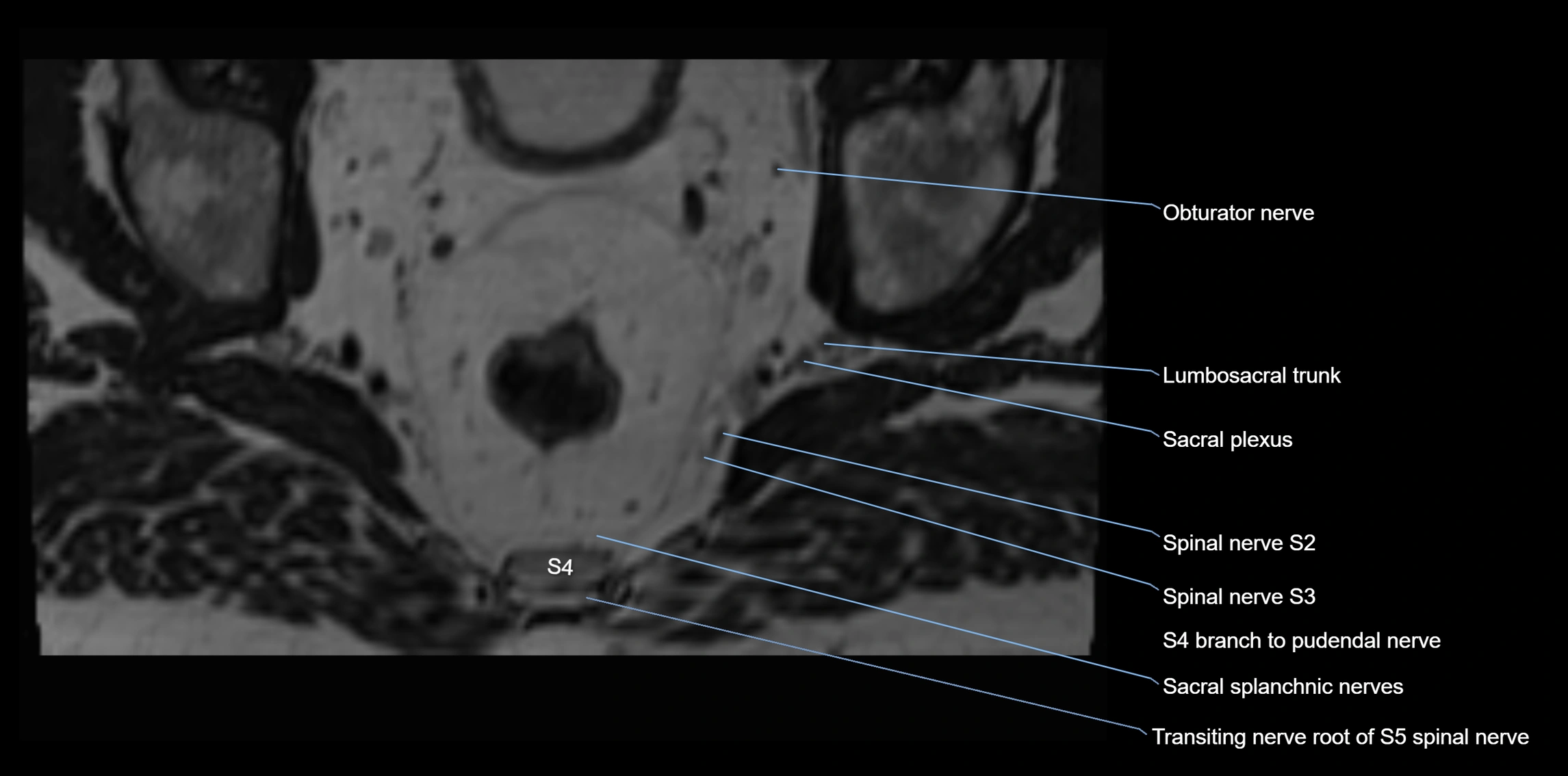 MR lumbosacral plexus axial cross sectional anatomy 3T  radiology  image-img-1008001-00106.webp